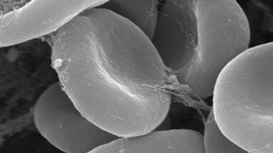 CRISPRビッグ3の1社、欧州で初の臨床試験実施へ