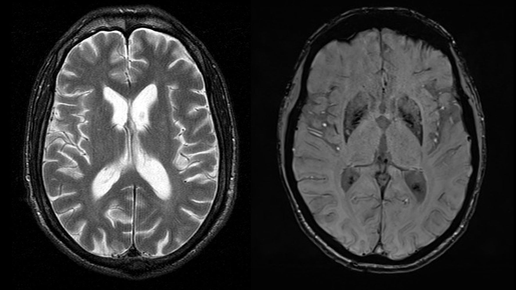 ハンチントン病患者に希望の光、遺伝子療法の治験で初の効果