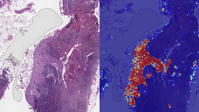 進行性乳がんを99％検出、グーグルのAIツールが「病理医超え」