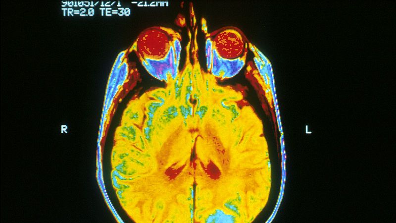 遺伝性アルツハイマーの発症を抑える遺伝子変異を発見